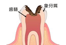 【虫歯中期症状2】